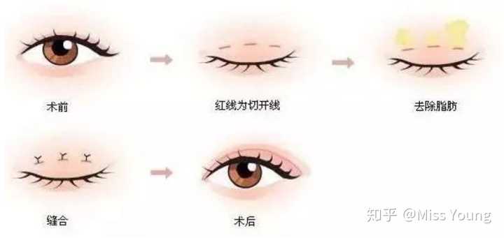 有没有内双也很漂亮的例子? - 知乎
