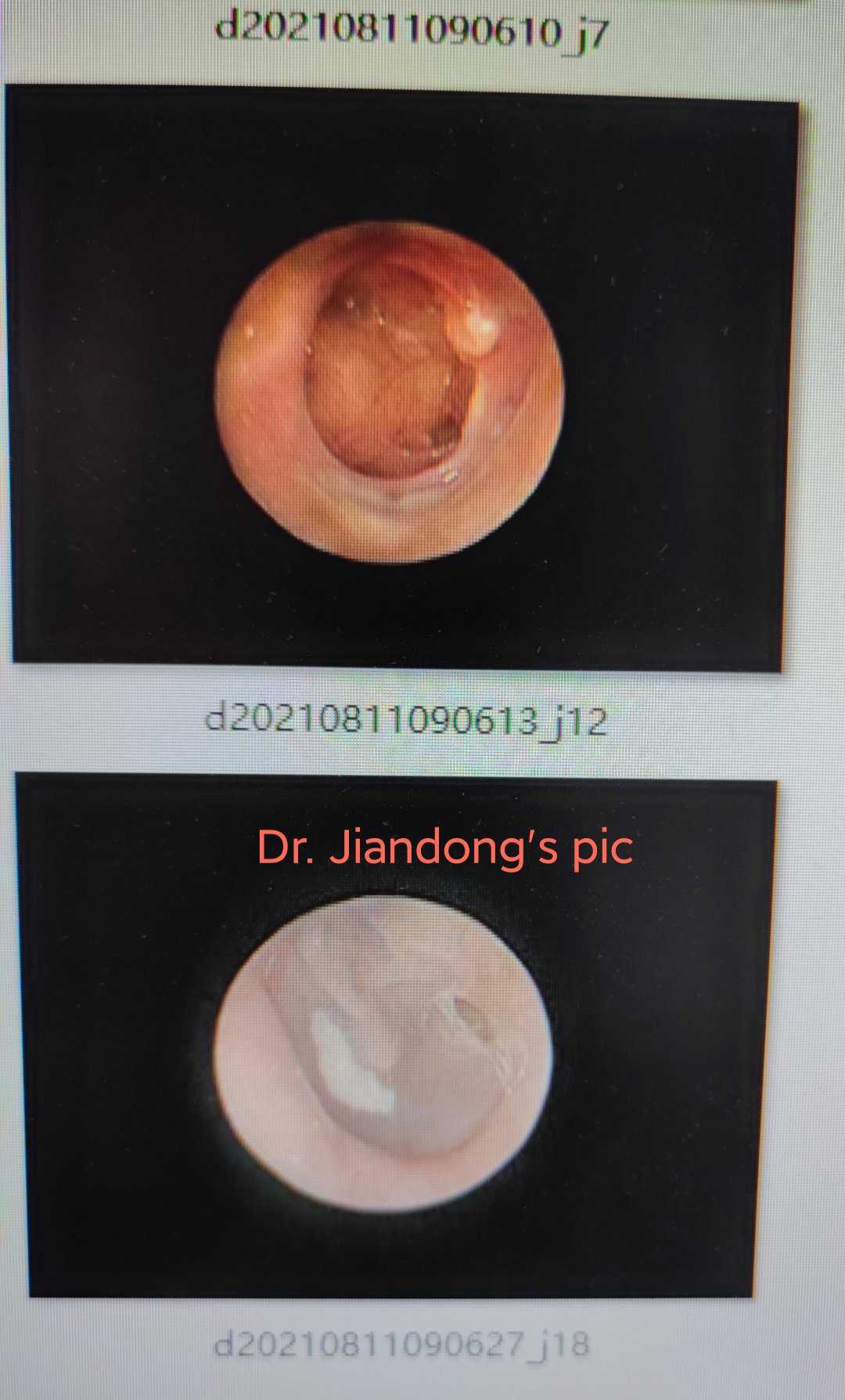 耳膜钙化斑图片