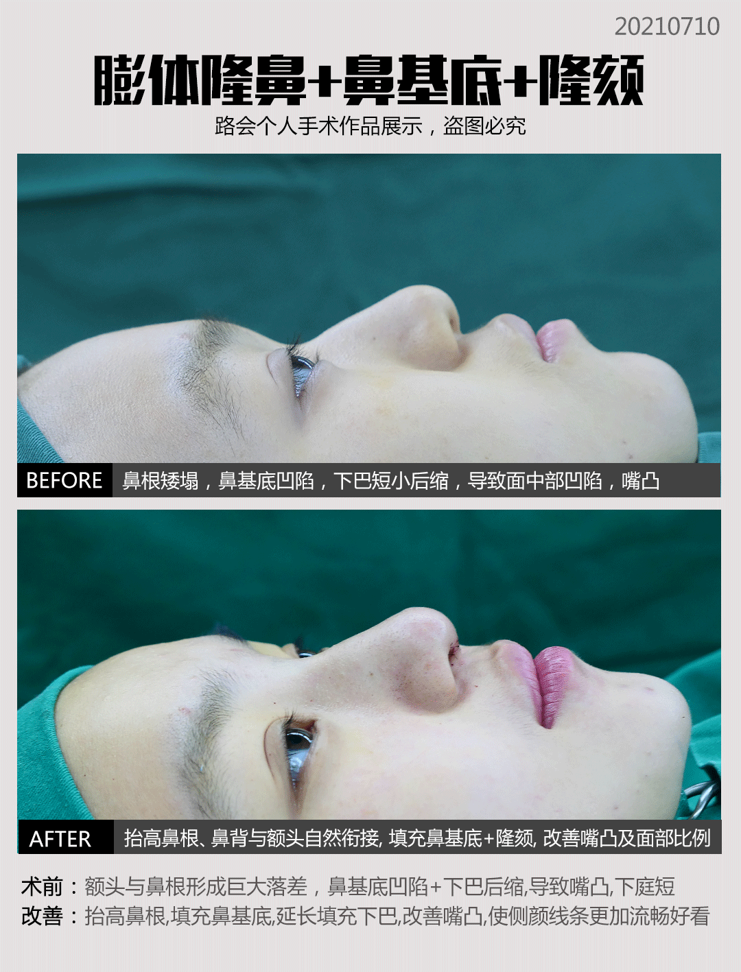 好填充鼻基底肋骨会移位吗_肋骨鼻基底填充好不好_鼻基底用肋骨填充会移位吗
