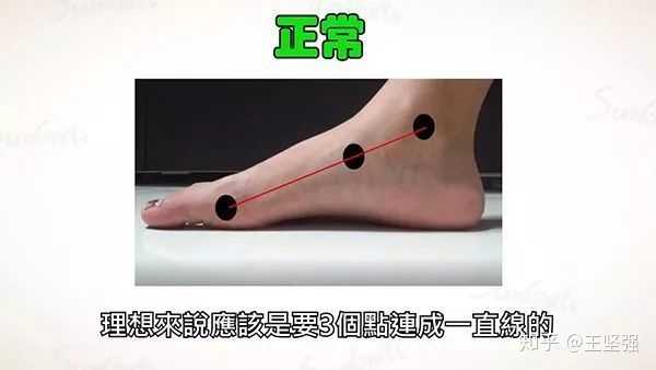 简单判断扁平足的方法,把脚底用水打湿,踩到一张白纸上面,看足底内侧