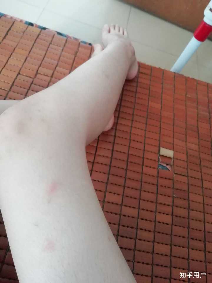 我是女生 腿上手上都有难看的疤痕 从小到大蚊子一咬就留疤 基本不敢
