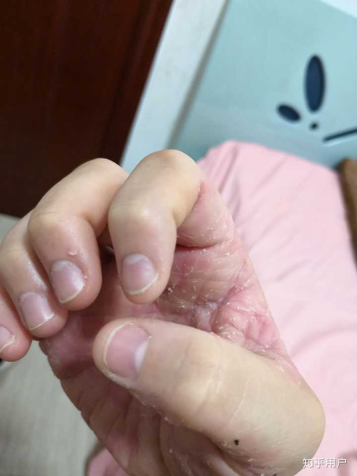 如何控制不自觉的没完没了的撕手皮如何恢复手指皮肤的状态比如已经撕
