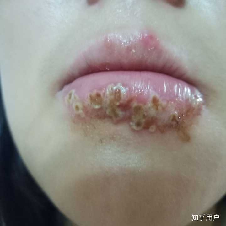 嘴唇可能长疱疹了以后肿了怎么办 知乎 嘴唇可能长疱疹了以后肿了怎么办 知乎