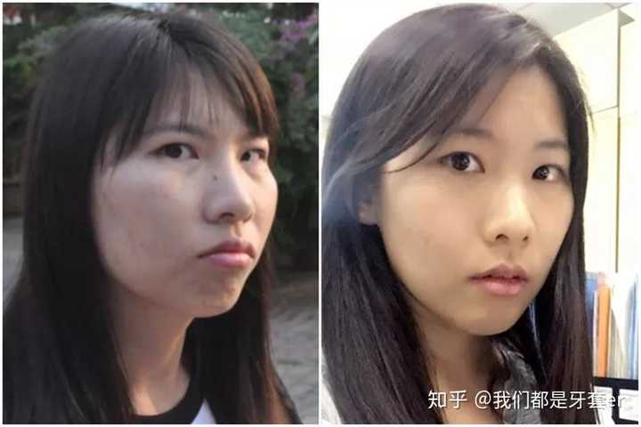 花十多万做正颌手术真的值得吗?