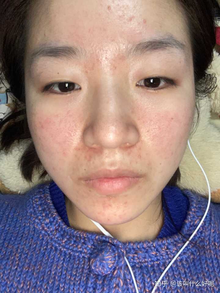 女性脸部脂溢性皮炎图片