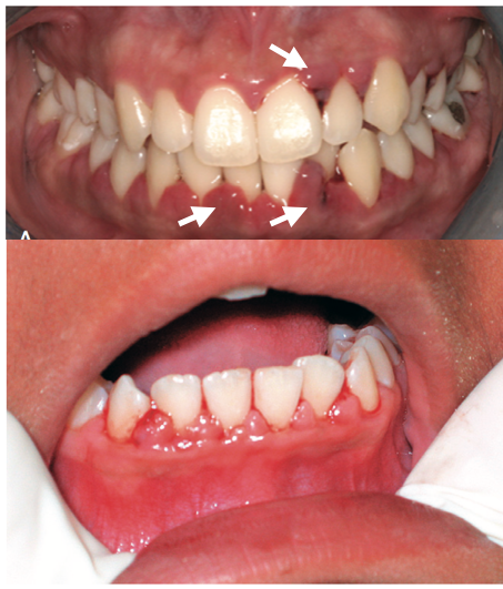 caries) 牙龈红肿出血不能等,进一步发展,严重了可能导致牙齿松动缺失