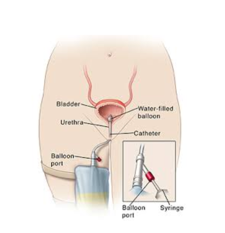 膀胱造瘘换管子图片图片