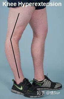 右腿为膝关节反张 图片来源:knee pain explained