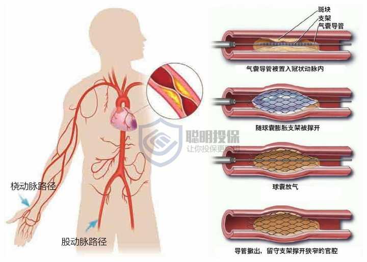 股动脉穿刺位置图片图片
