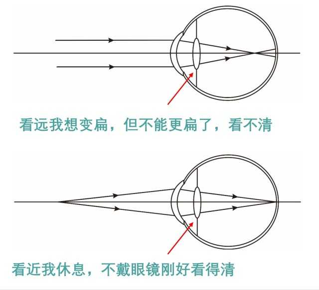 近视眼将来不用戴老花眼镜吗?