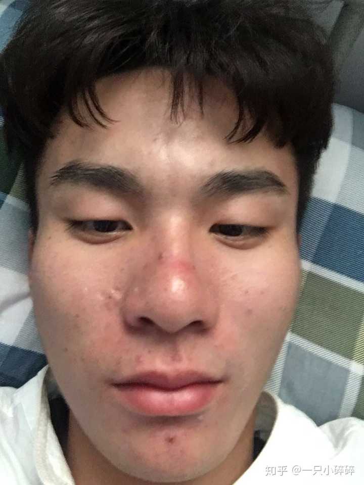 一个183五官帅的男生长了一脸痘痘痘印是什么体验?