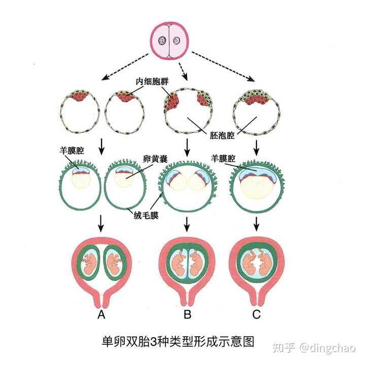 图六 单卵双胎3种类型形成示意图(图片来源 李继承.组织学与胚胎学.