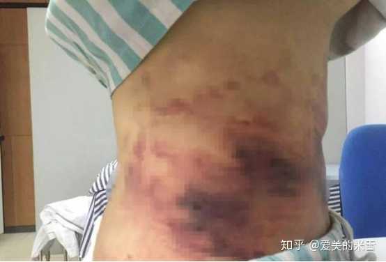 腹部吸脂需要多少费用? - 知乎