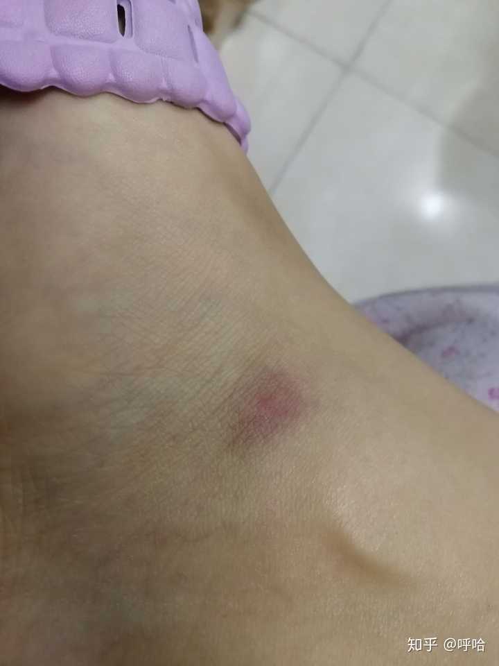 被蚊子咬后的奇葩症状 知乎 被蚊子咬后的奇葩症状 知乎