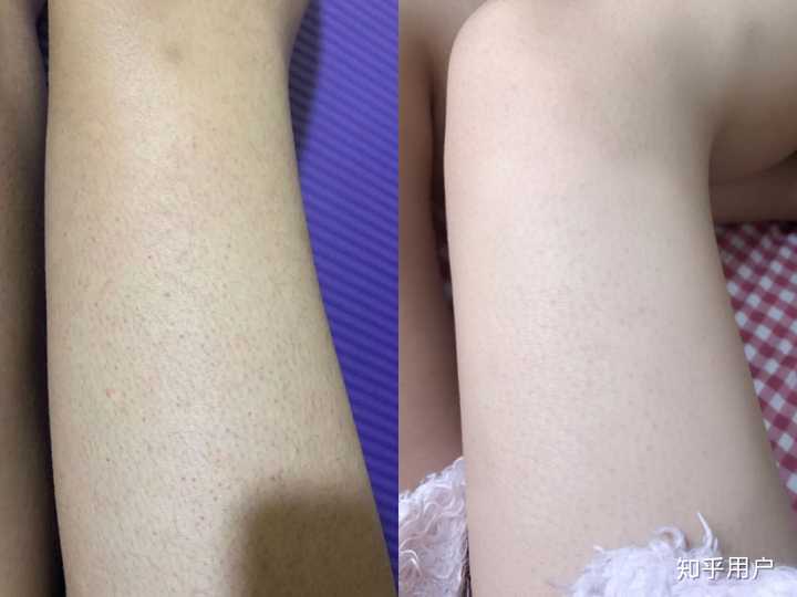 什么样的皮肤需要去角质 去角质有什么作用 知乎 什么样的皮肤需要去角质 去角质有什么作用 知乎