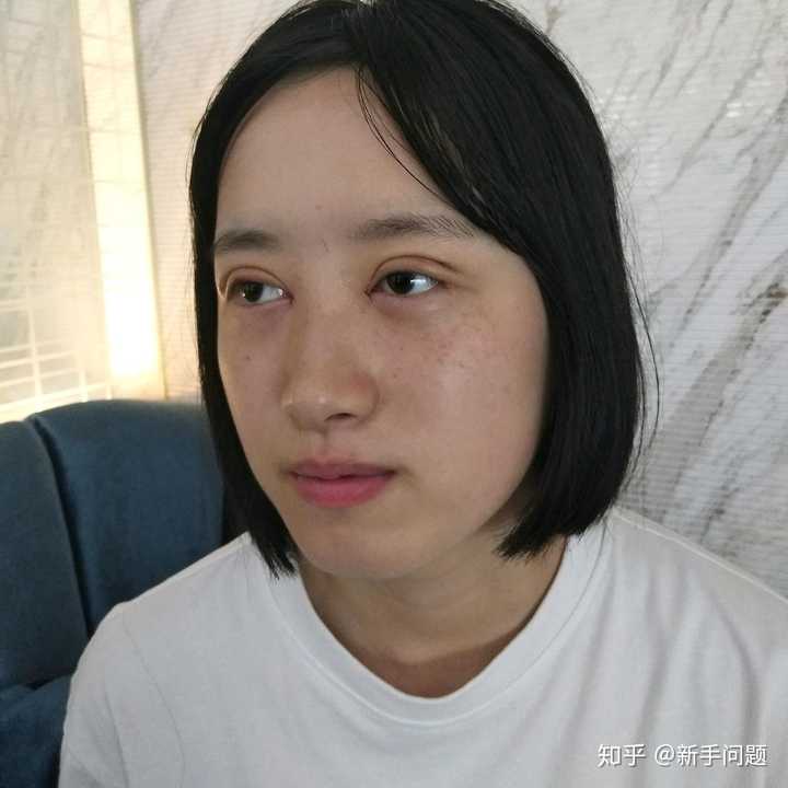 想知道有没有在福建省立医院丁力医生那里做过双眼皮的姐妹显示全部