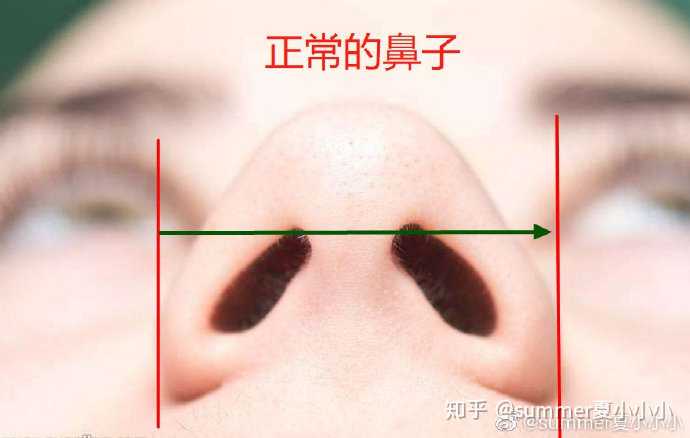 单纯缩鼻翼可以改善我的五官吗?