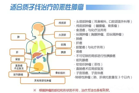 上海质子重离子医院值不值得去 国外有没有对应的技术 为什么从来没有听说过 知乎