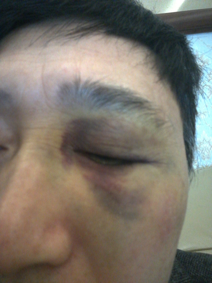 摔跤导致颧骨和眼眶淤青,怎么快速去除?