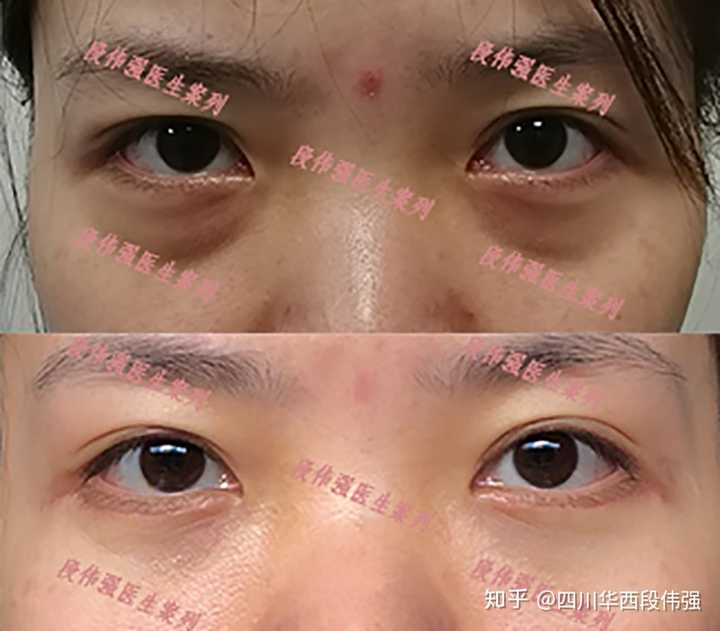 我这眼袋是真性眼袋还是假性眼袋?