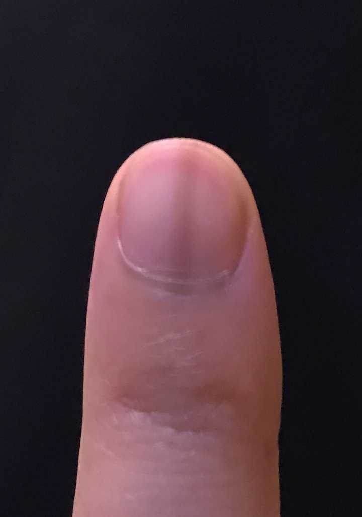 大拇指指甲上有一道黑线 都有四年左右了是什么情况?