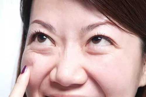 怎样去除下眼袋的浮肿 知乎 怎样去除下眼袋的浮肿 知乎