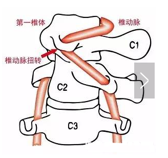 尤其是第一頸椎發生旋轉型的偏位會很嚴重