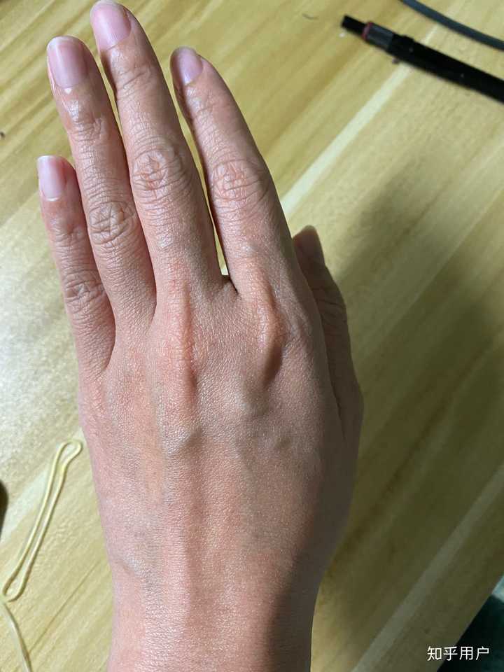 年纪轻轻23岁手上皮肤就很干有很多皱纹,像老年人干瘪的手,怎么办呀?