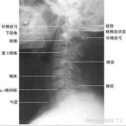 如何从颈椎病的阴影调整回来 知乎