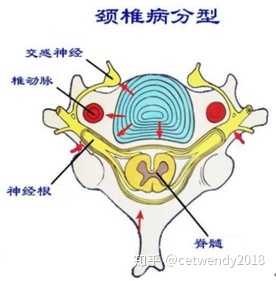 颈椎病的明显症状有哪些 知乎