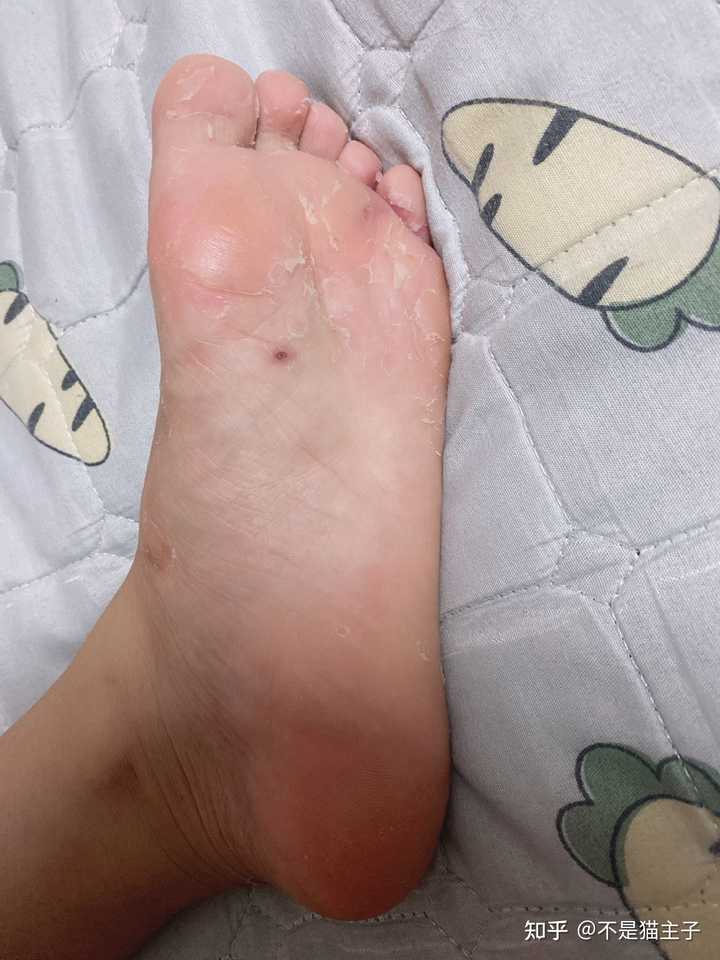 脚气和脚气病是否不一样 知乎 脚气和脚气病是否不一样 知乎