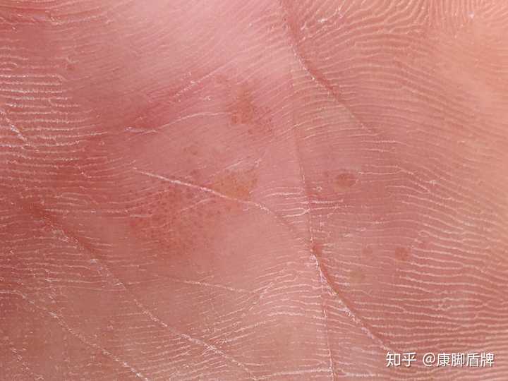 小水泡涂达克宁可以吗?