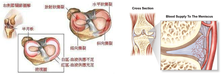 为什么半月板不能自动修复 知乎