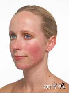 什么是玫瑰痤疮