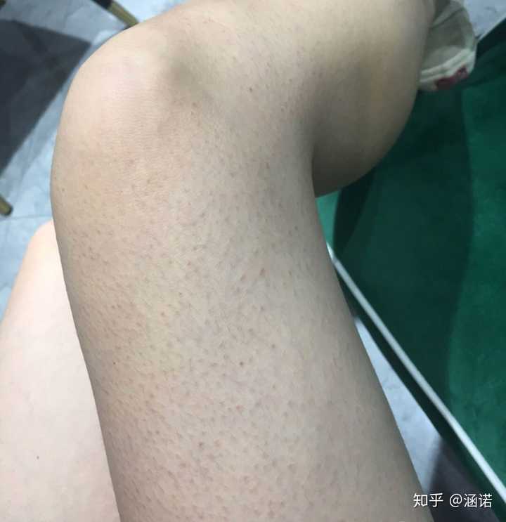 鸡皮肤冬天症状(鸡皮肤为什么冬天比较严重)