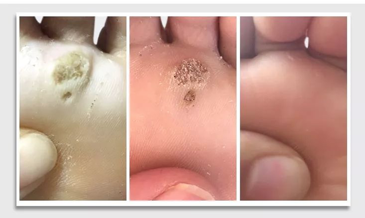 刺猴,一般指寻常疣,如果发生在足底,就是跖疣.