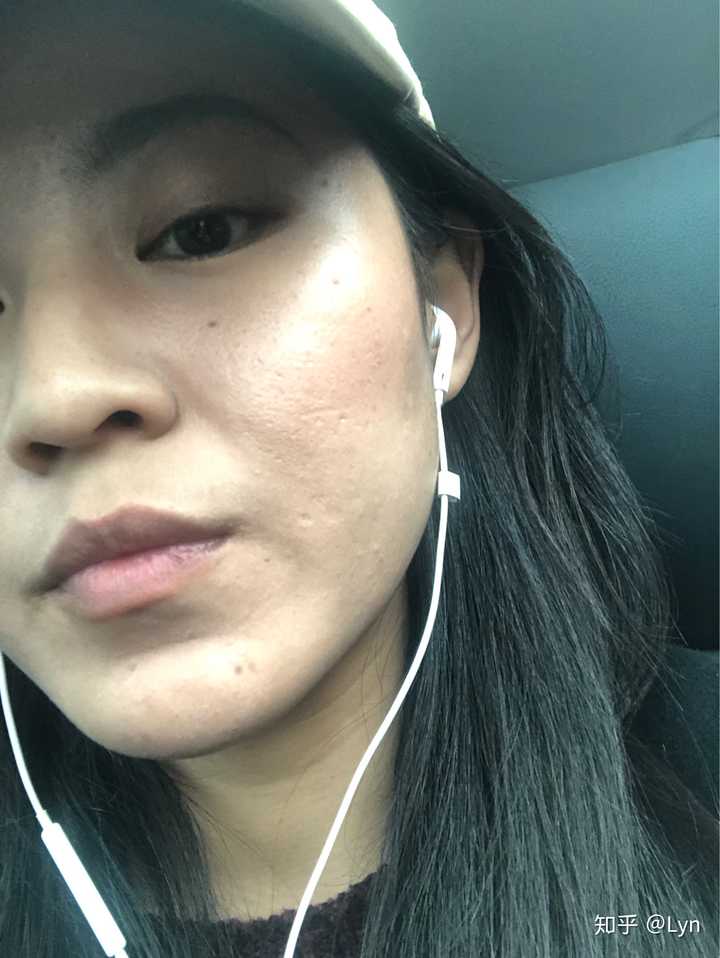 怎么看待五官漂亮但是皮肤差的女性?