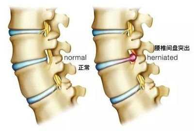 看!腰椎間盤突出就是被你這樣