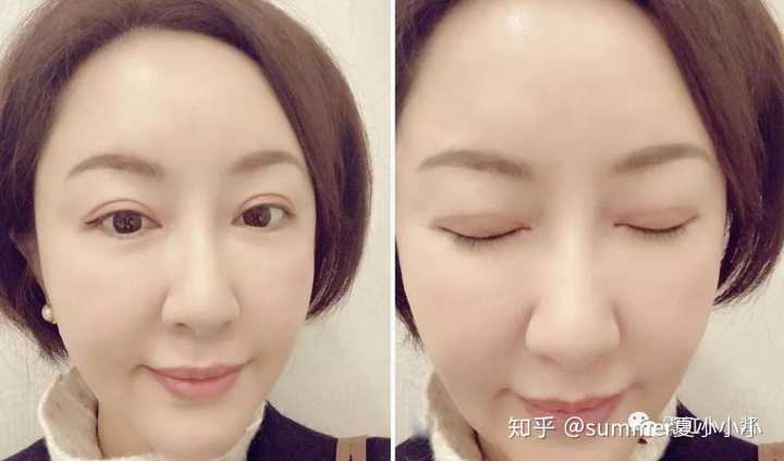 做上眼睑下垂手术是一种怎样的体验?