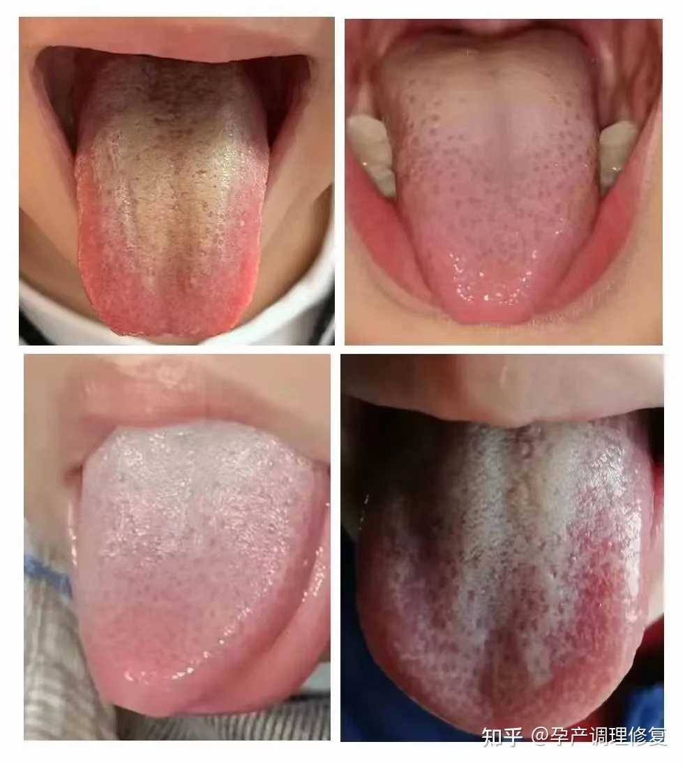我自己小孩每天多会问大便,看舌苔,积食了消化不了,就会运化热,发烧