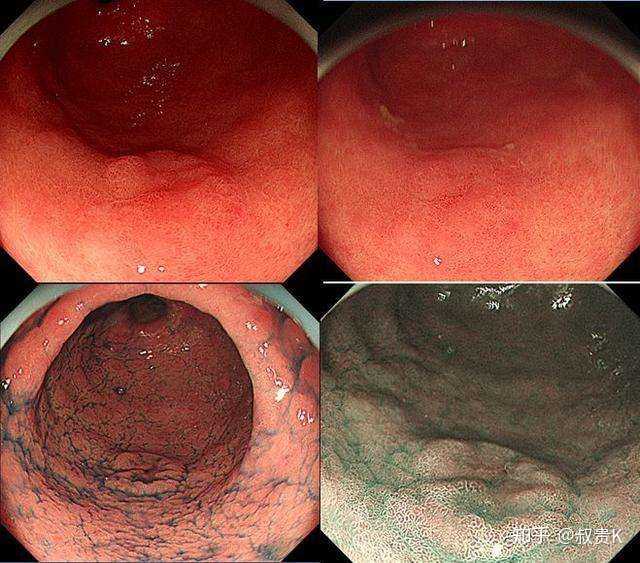 一个胃从完好到报废,就是这样坚持不懈的「作」出来的.