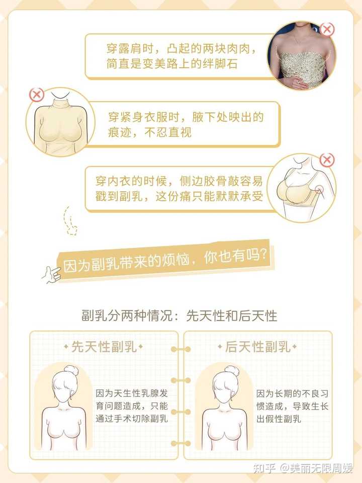 副乳大成这样正常吗？