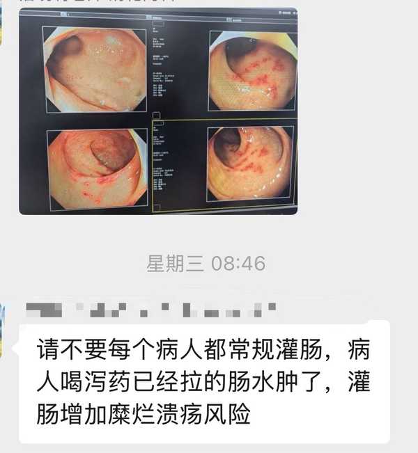 阿里第三个癌症筛查模型登上顶刊，首次实现肠癌无感筛查，未来用「平扫CT+AI」能实现多癌筛查吗？