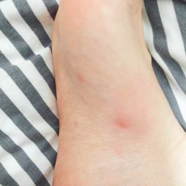 蚊子咬脚心图片