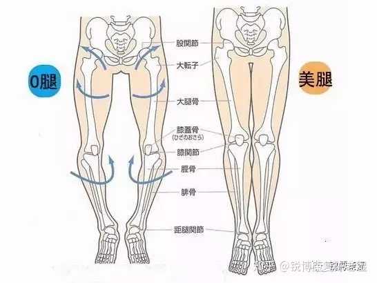 如何矫正罗圈腿 O型腿 知乎