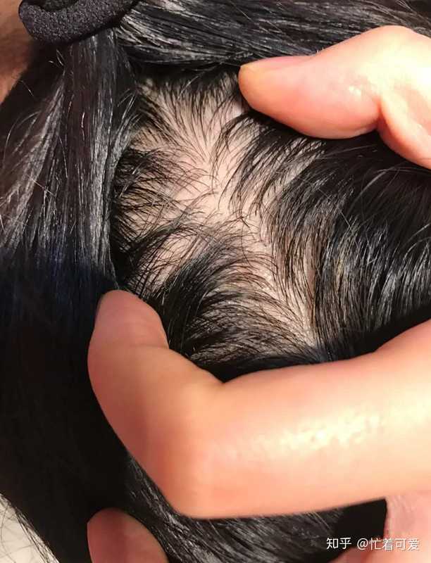 有什么好的方子可以生发？