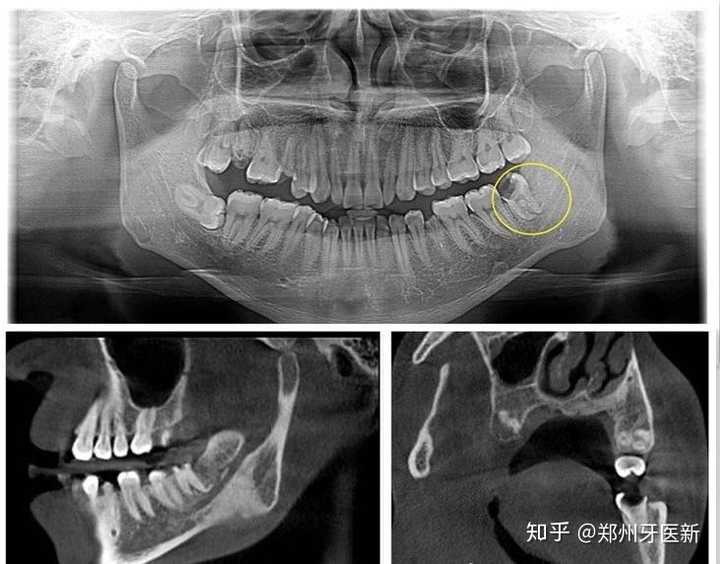 为什么拔智齿医生让拍片子