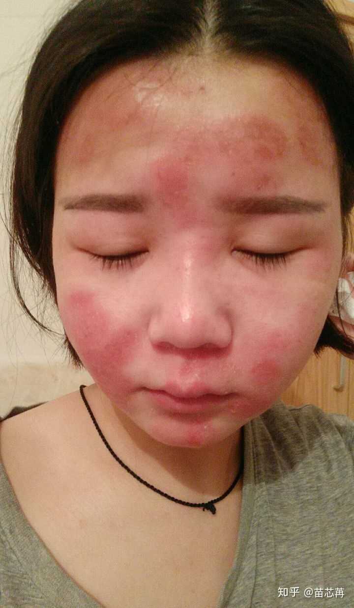选择温和补水的护肤品进行护肤,减少对皮肤的刺激,尽量减少更换护肤品