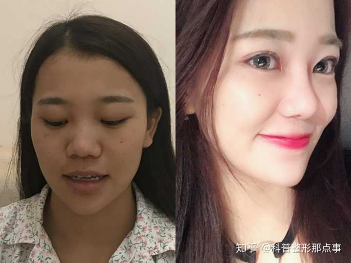 一般的整容手术成功率有多高 知乎 一般的整容手术成功率有多高 知乎