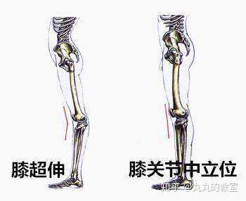 想请问一下,怎样判断属不属于膝超伸?